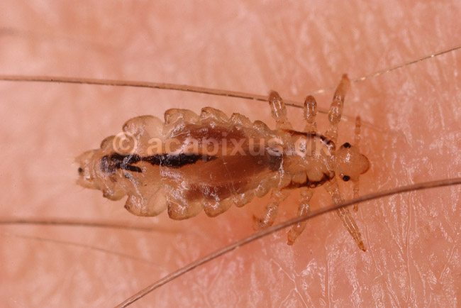 Hovedlus. Hoved lus; Pediculus humanus capitis; ; ; ; insekter; Egentlige lus, Siphunculata, ut�j, skadedyr, h�r, hovedbund, plettyfus
